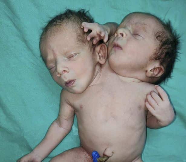 bayi-dua-kepala - The Malaysia Life